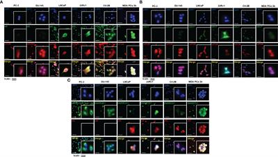 Tumor suppressive miR-99b-5p as an epigenomic regulator mediating mTOR/AR/SMARCD1 signaling axis in aggressive prostate cancer